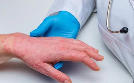 وزارة الصحة: لم يتم تسجيل أي حالة جديدة بجدري القرود في لبنان منذ شهر آذار الماضي