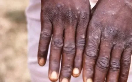 إفريقيا تسجل أكثر من 18 ألف حالة جدري قردة محتملة