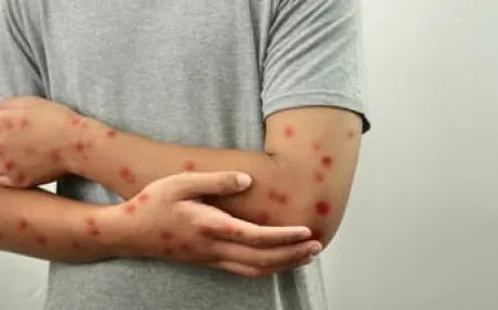 وقاية: لم يتم رصد فيروس "جدري القردة" في السعودية حتى الآن